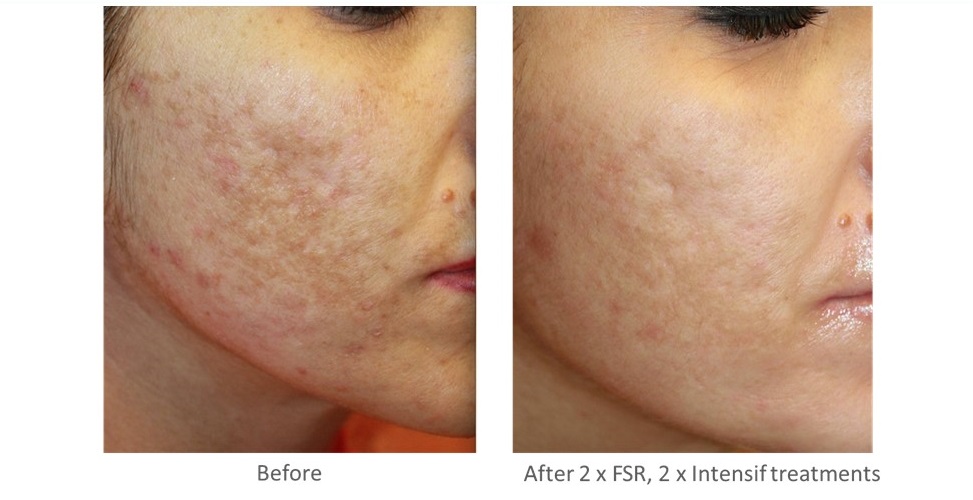 Periorbital Rejuvenation with Endymed iFine