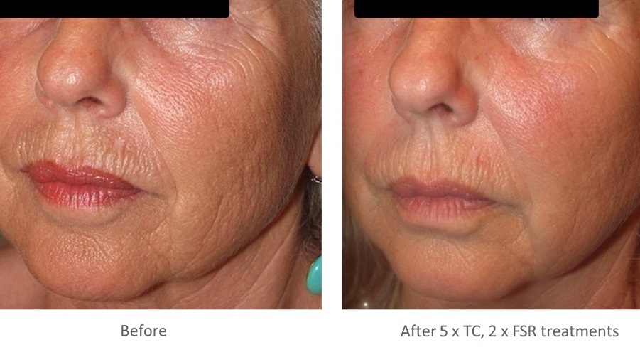 Acne Scar Revision Before and After Clinical Transformation