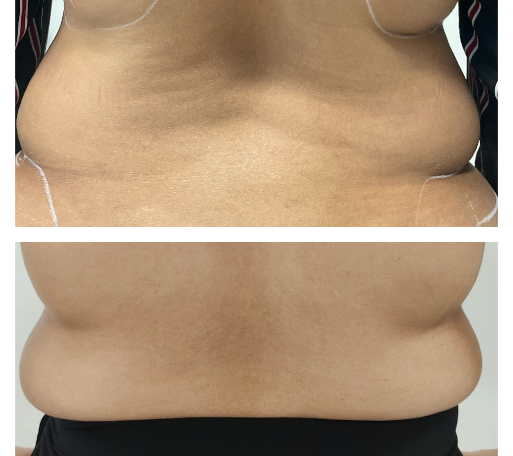 Postpartum Mummy Makeover Non-Surgical Rehabilitation