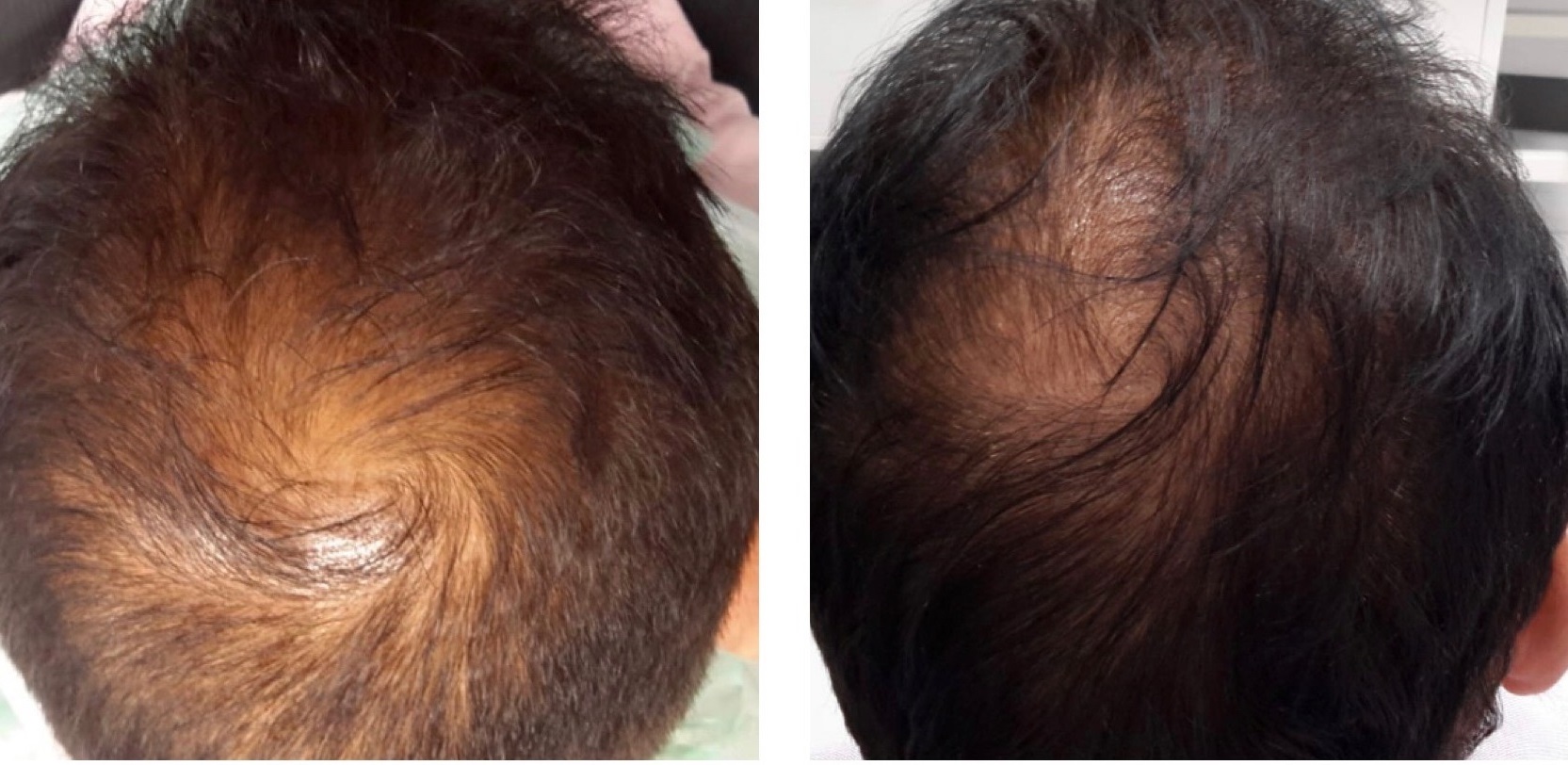 Regenera Activa Hair Micrografting by Dr. Masuma Molvi