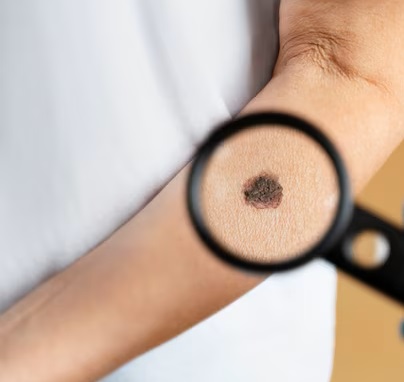 Mole Dermatoscopy and Digital Mapping at Derma Vogue